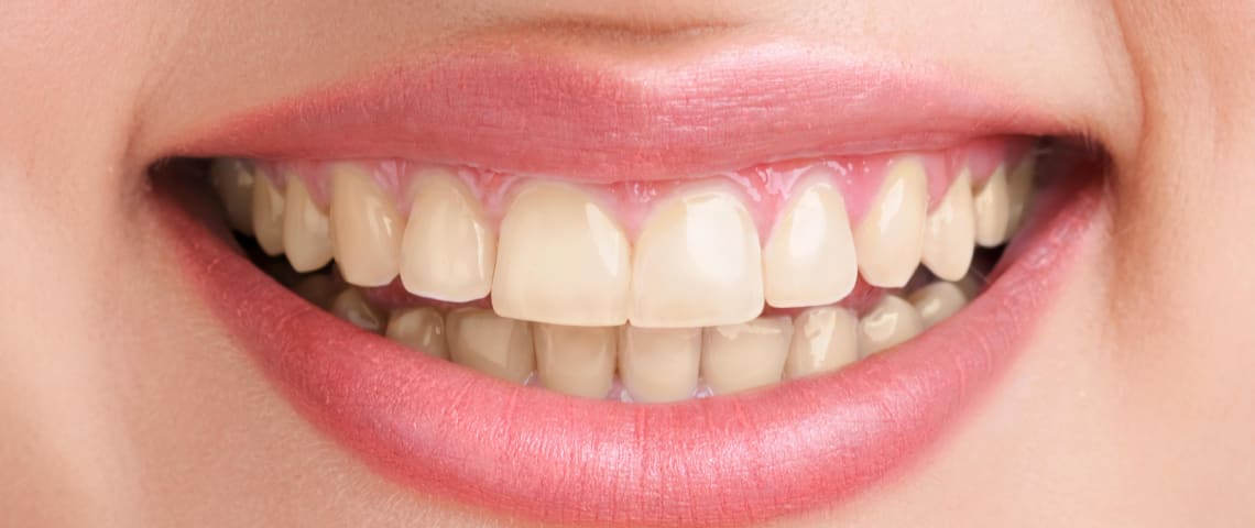 Teeth Whitening in Ras Al Khaimah - Before