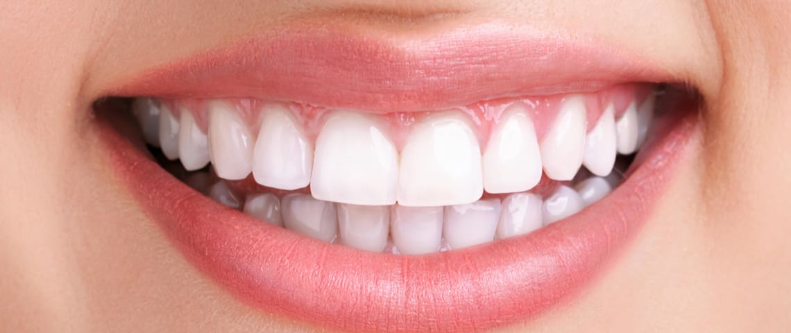 Teeth Whitening in Ras Al Khaimah - After