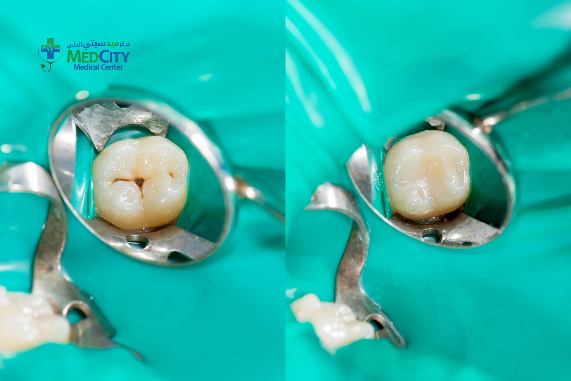 Composite Dental Bonding in Ras Al Khaimah