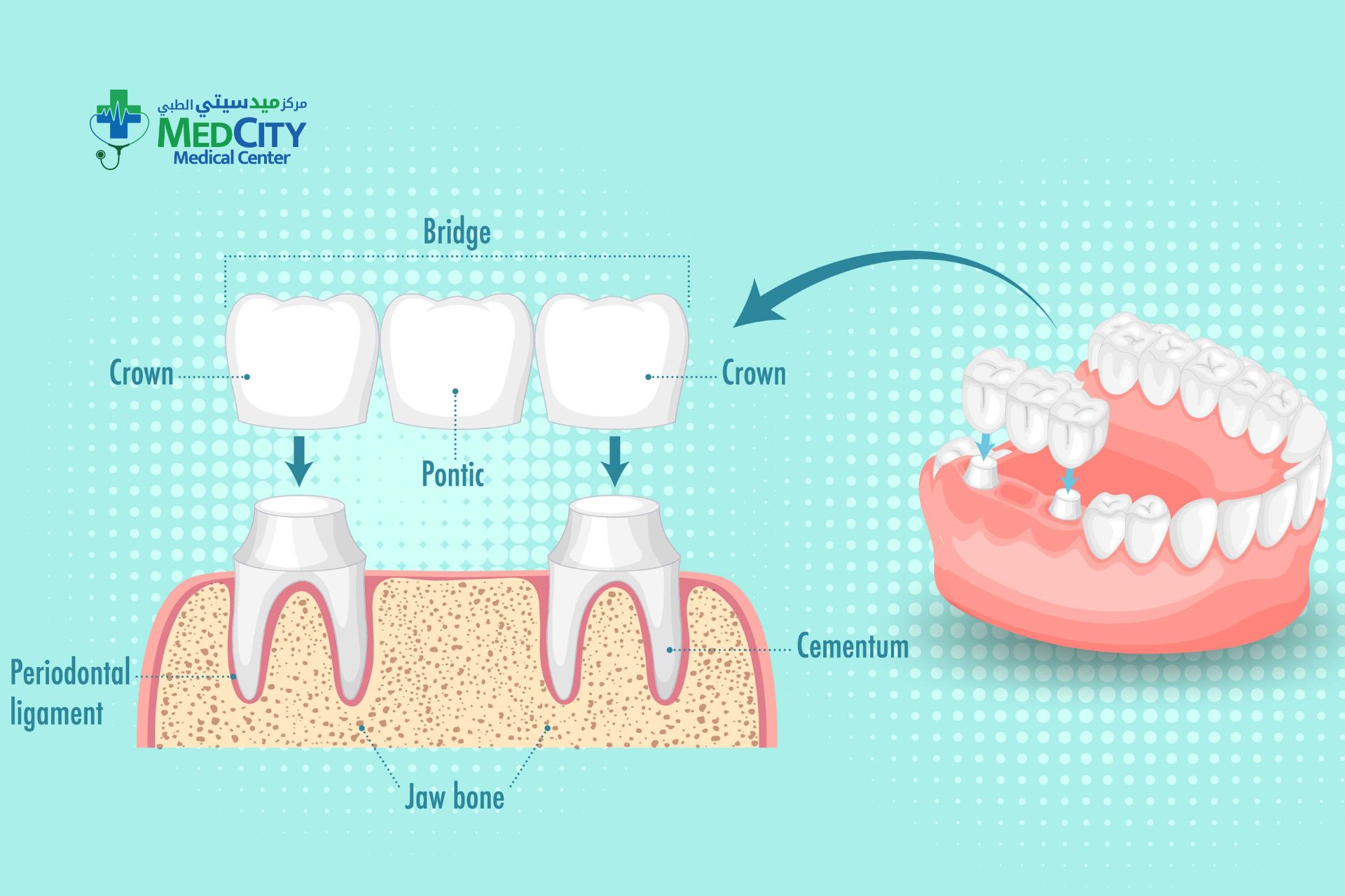 Dental Crown and Bridges in Ras Al Khaimah