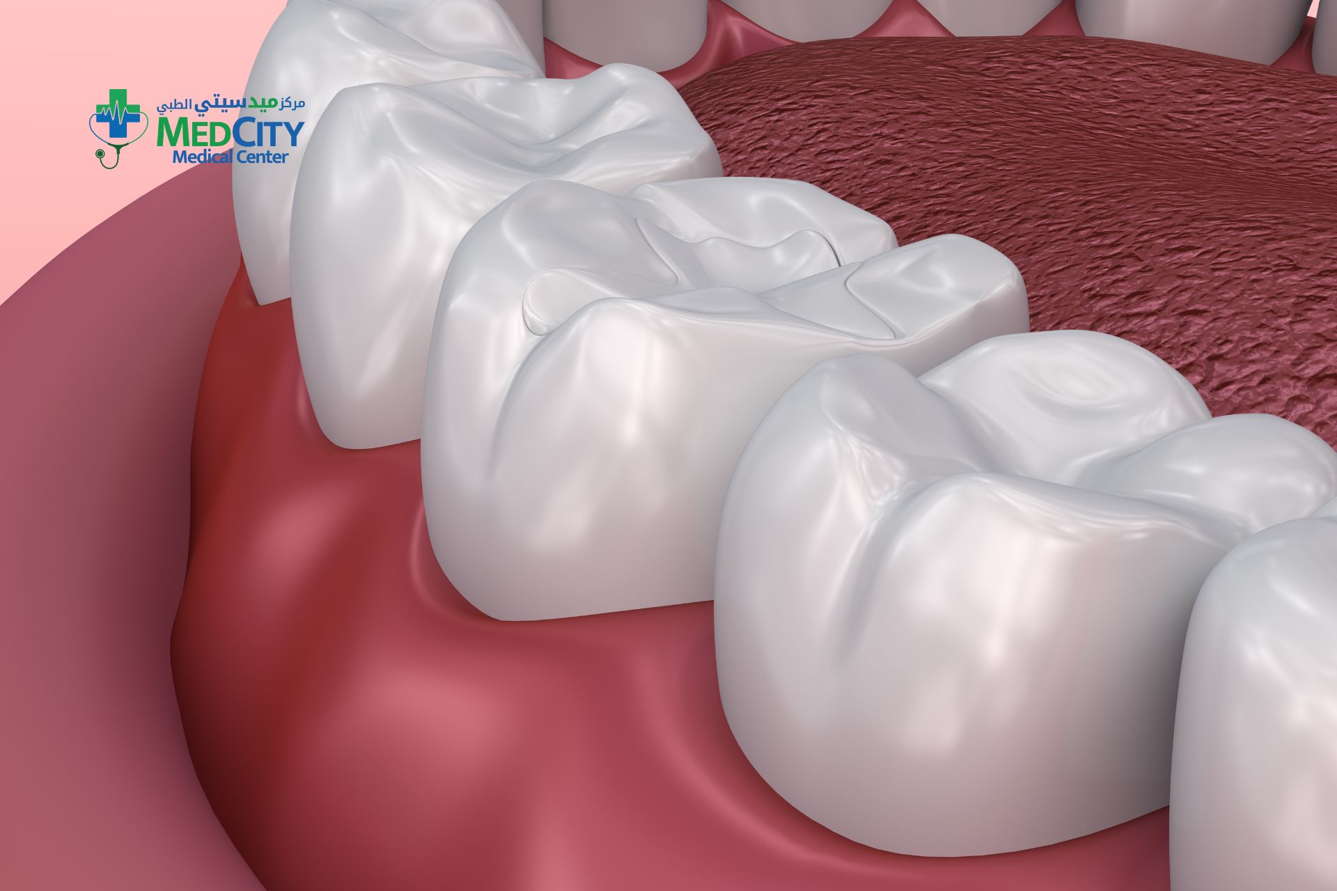 Dental Filling in Ras Al Khaimah