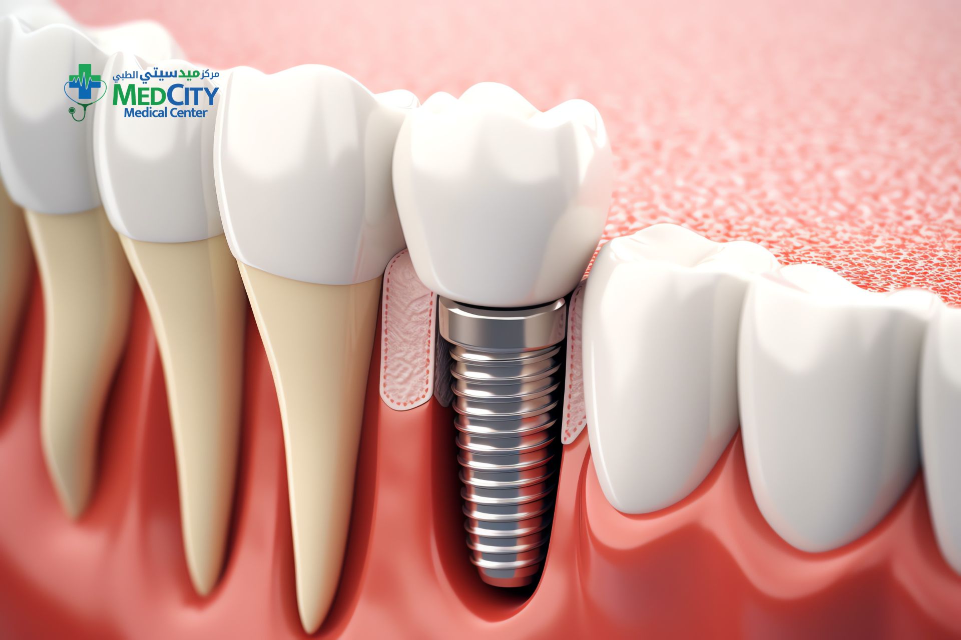Dental Implant in Ras Al Khaimah