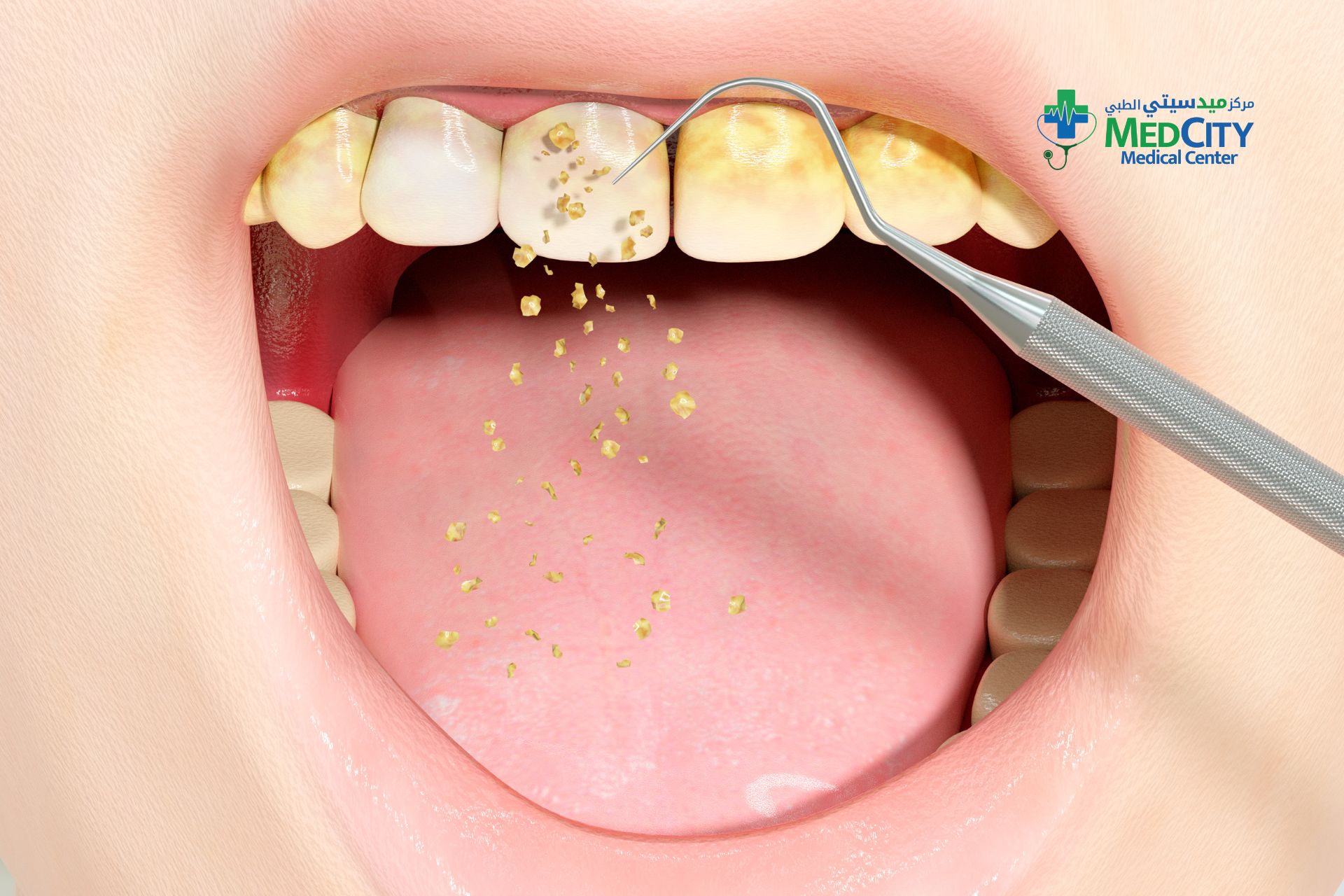 Dental Scaling and Polishing in Ras Al Khaimah