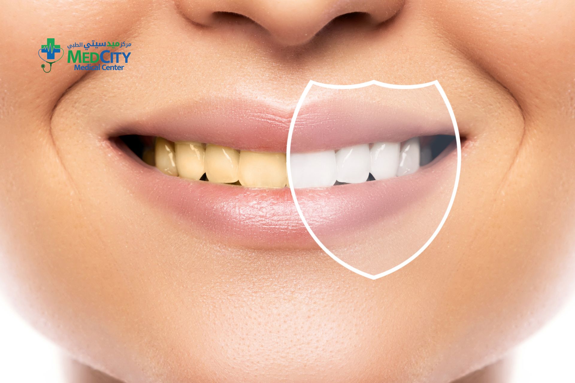 Teeth Whitening in Ras Al Khaimah